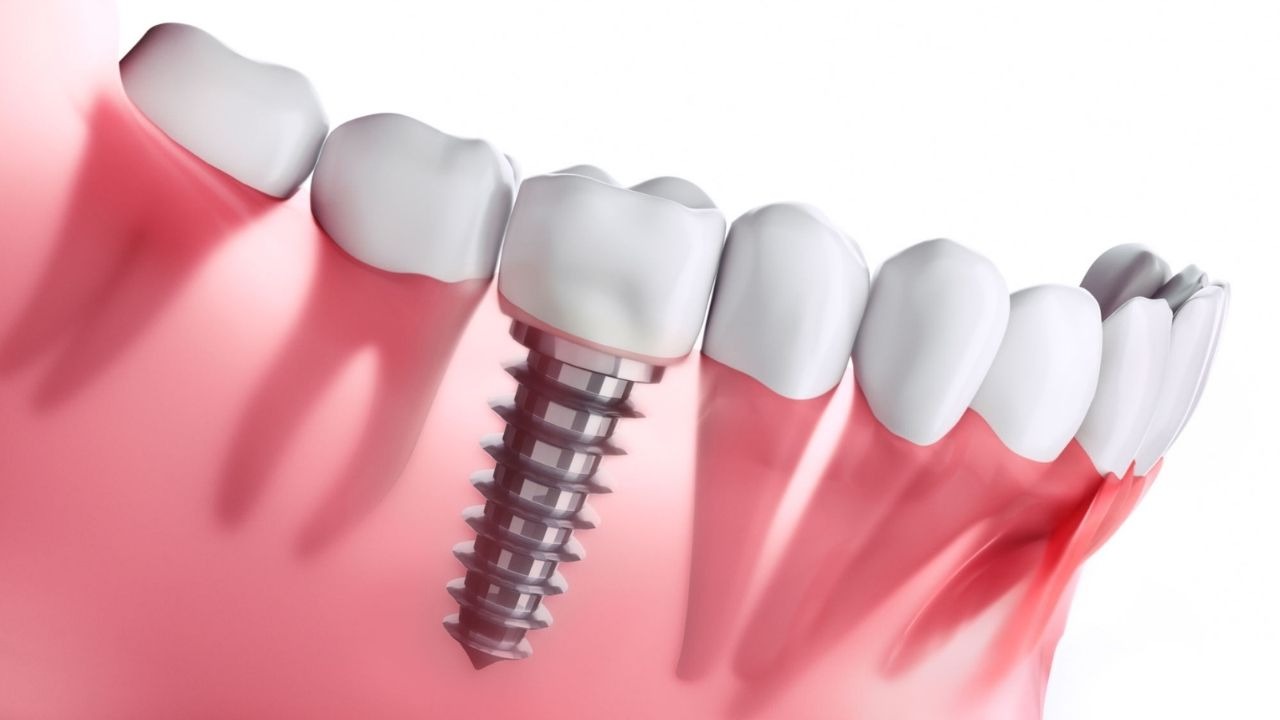 Qual a Diferença entre Implante Dentário e Prótese Dentária?